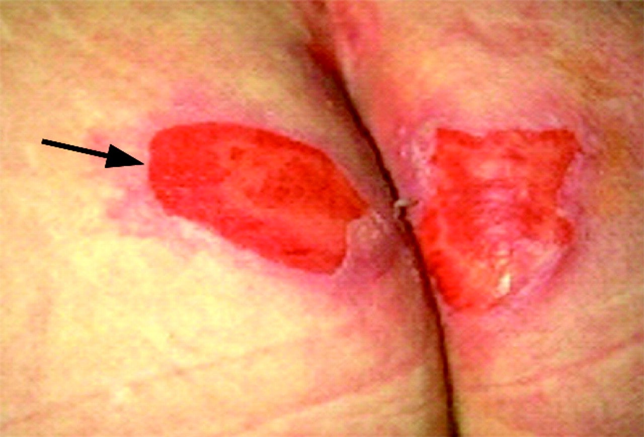Pressure Ulcer Pictures | Images of Pressure Ulcers